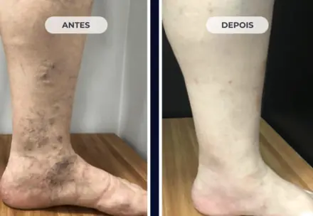 Varizes visíveis na perna antes do tratamento
